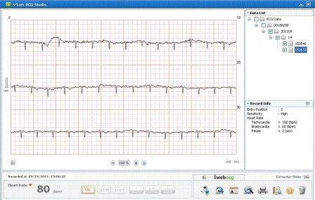 beurer® Medical ME 90 Mobiles Bluetooth EKG Gerät mit Auswertung
