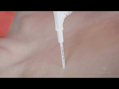 Prometheus Medical™ Russell PneumoFix®-8 Thoraxpunktionsnadel | 14G