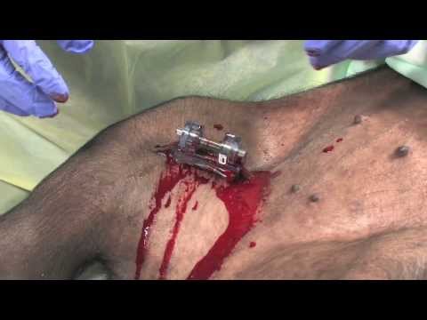 iTraumaCare® iTClamp™ Wundklammer / Hemorrhage Control