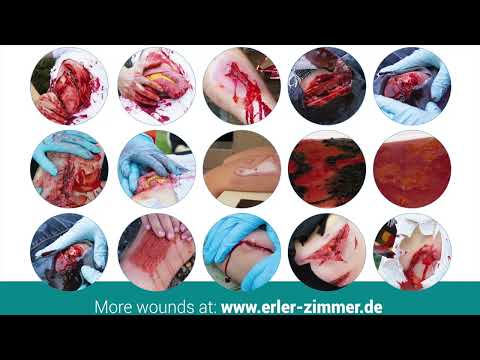 Erler Zimmer Wundmoulage offener Knochenbruch
