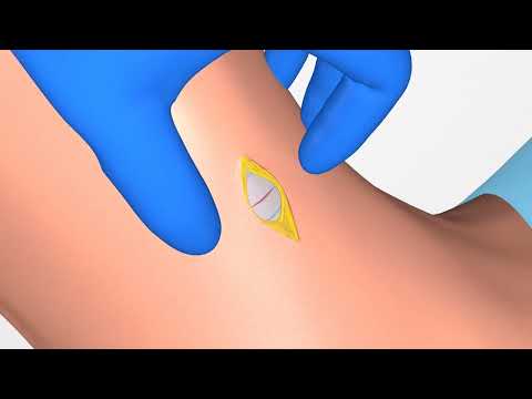 VBM® Surgicric II Chirurgisches Koniotomie Set | Klassische Technik