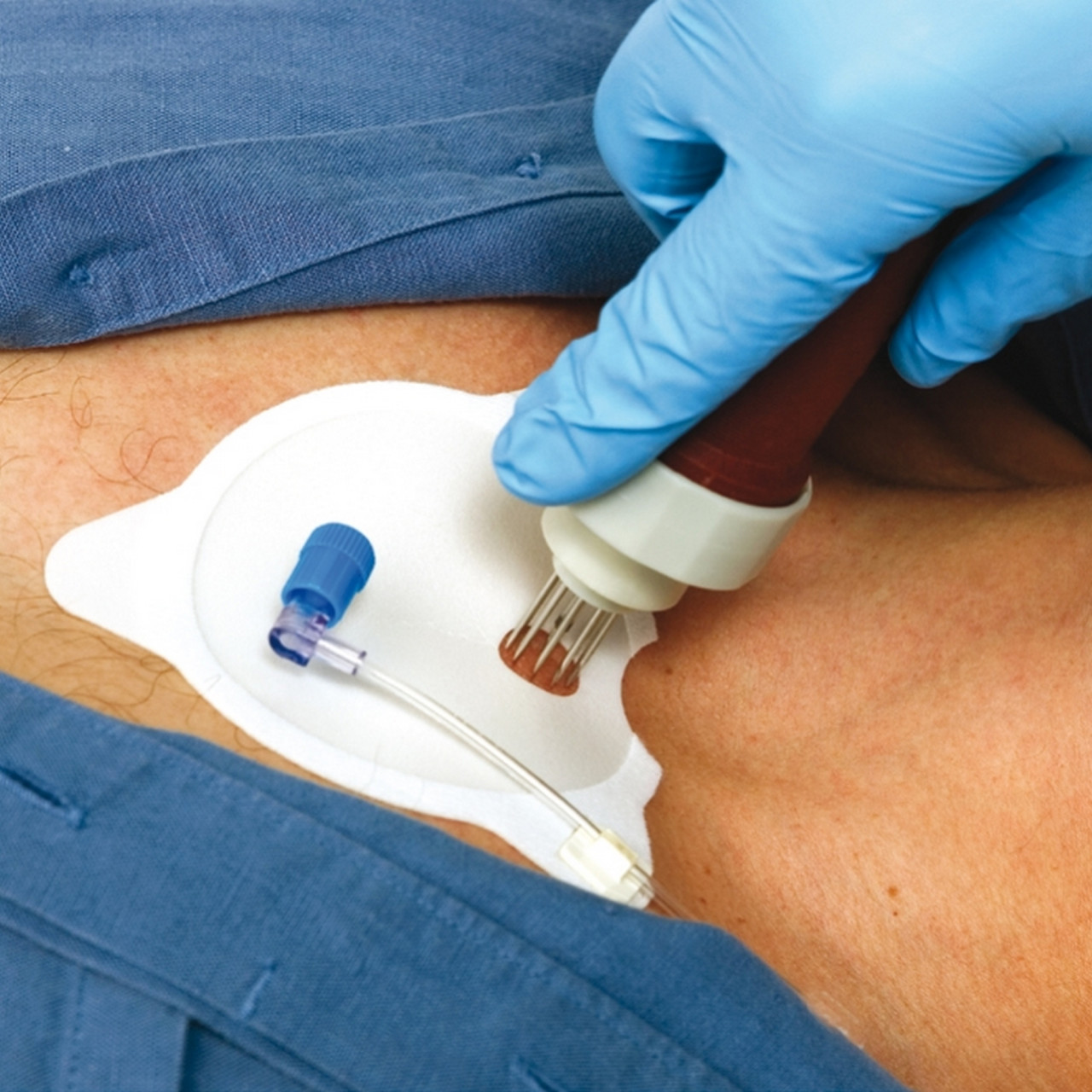 Arrow® FAST1™ Intraossäres Infusions-System / Sternum IO | Meier ...